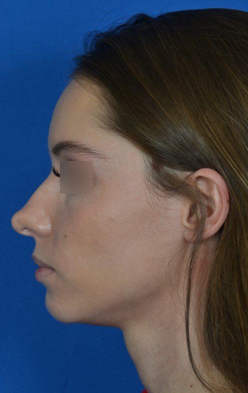 female rhinoplasty