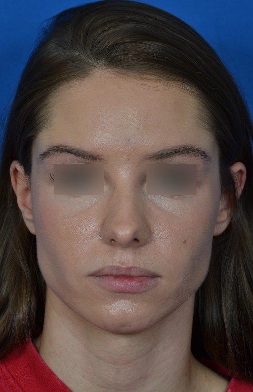 rhinoplasty