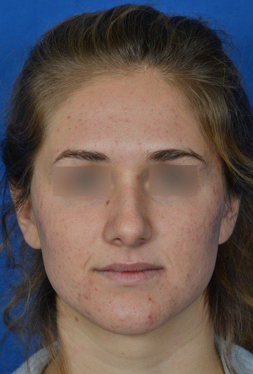 female rhinoplasty