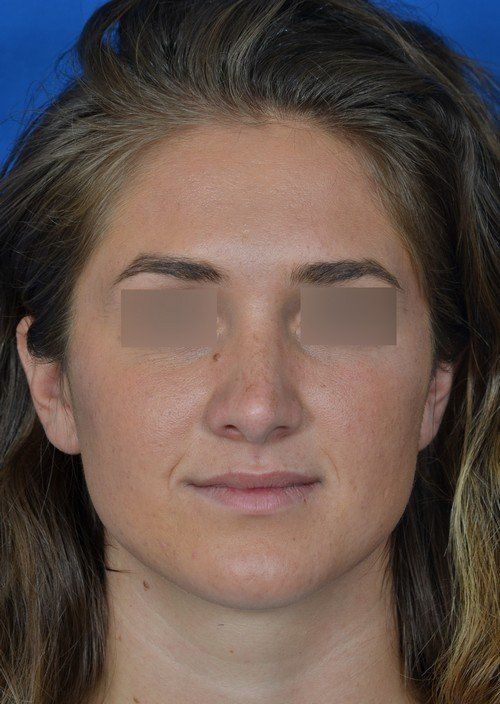 female rhinoplasty