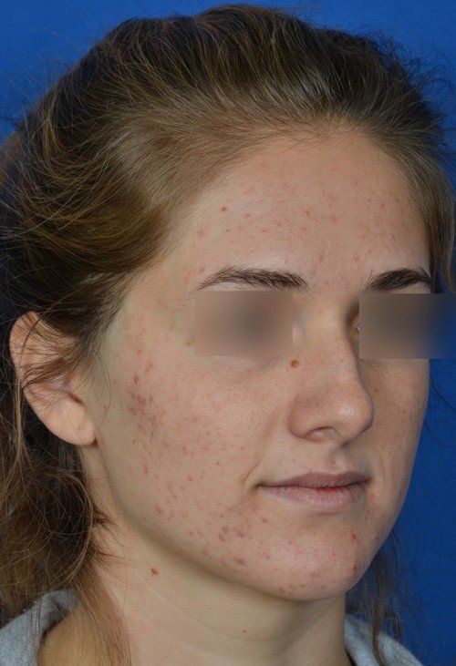 female rhinoplasty