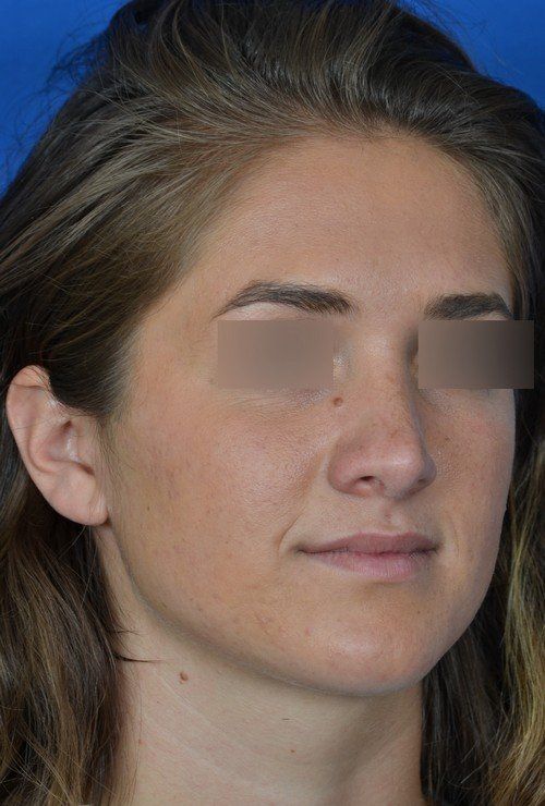 female rhinoplasty