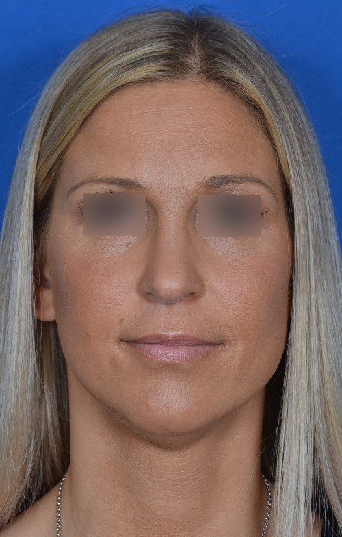 female rhinoplasty