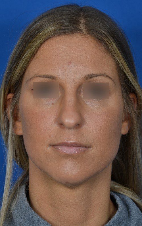 before rhinoplasty