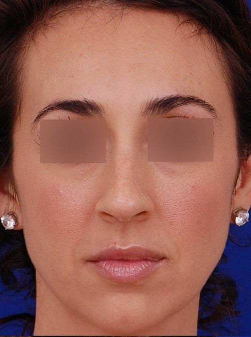 female rhinoplasty