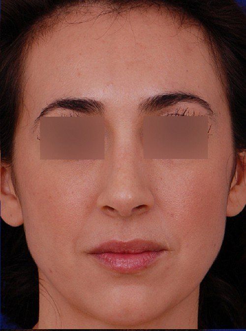female rhinoplasty