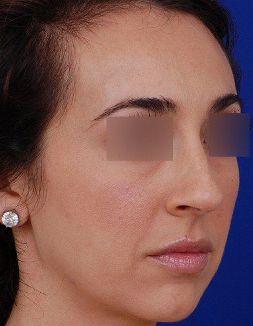 female rhinoplasty