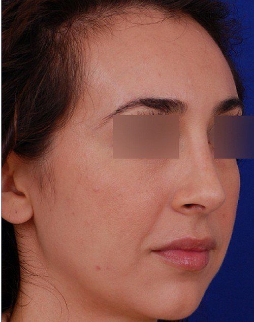 female rhinoplasty