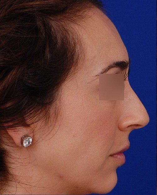 female rhinoplasty