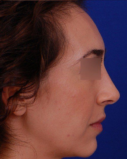 female rhinoplasty