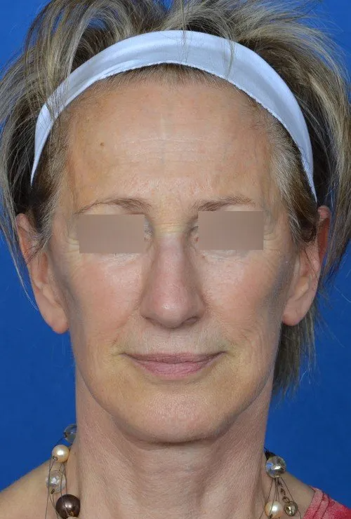 female facelift