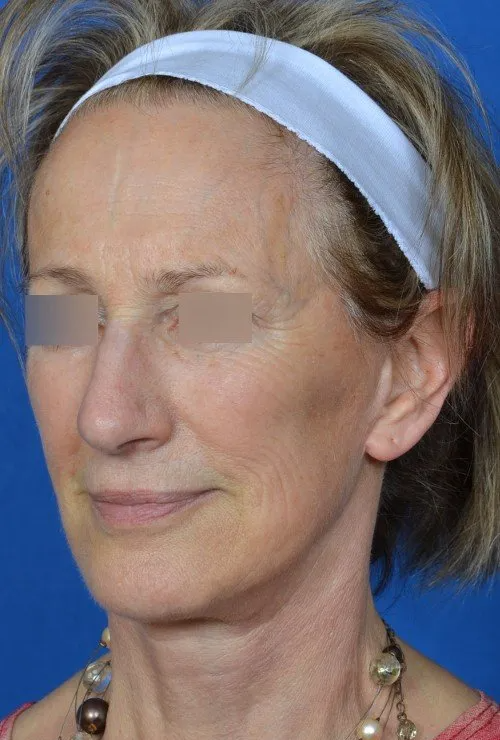female facelift