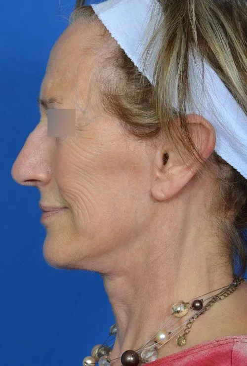 female facelift