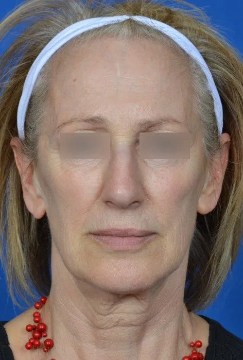 female facelift