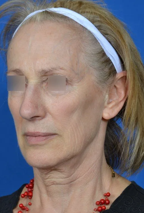 female facelift