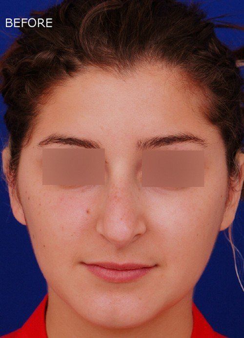 revision rhinoplasty