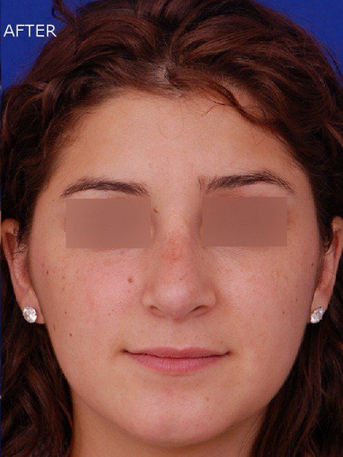 female revision rhinoplasty