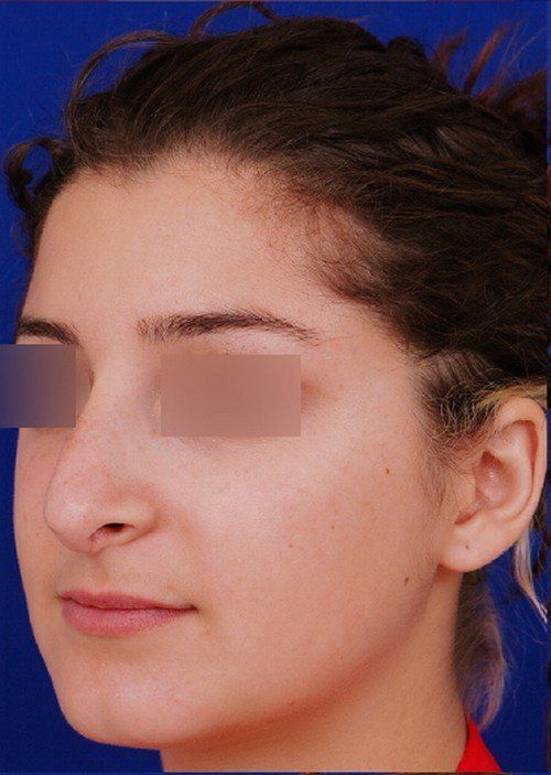 revision rhinoplasty