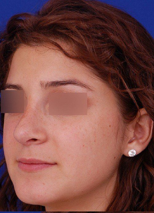revision rhinoplasty