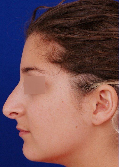 revision rhinoplasty