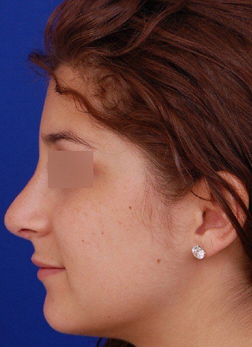 revision rhinoplasty