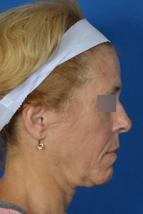 mini facelift before and after