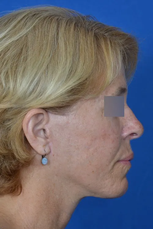 mini facelift before and after