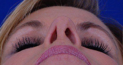 female revision rhinoplasty