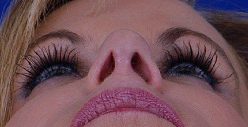 female revision rhinoplasty