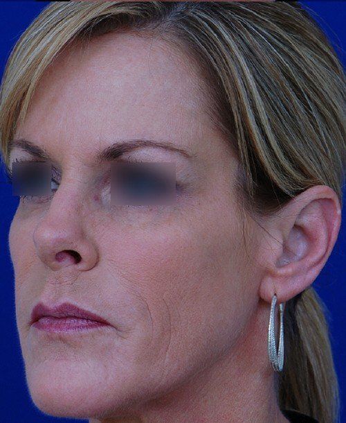 female revision rhinoplasty