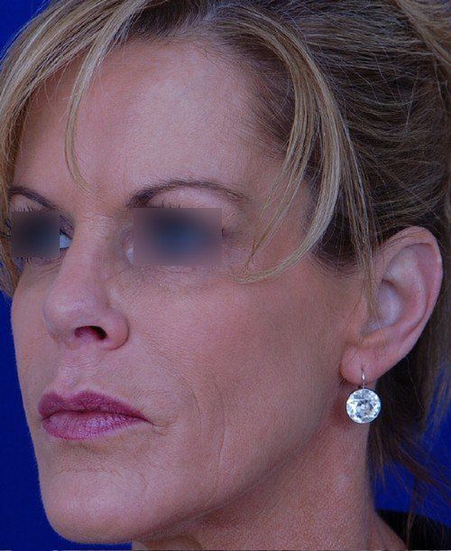 female revision rhinoplasty