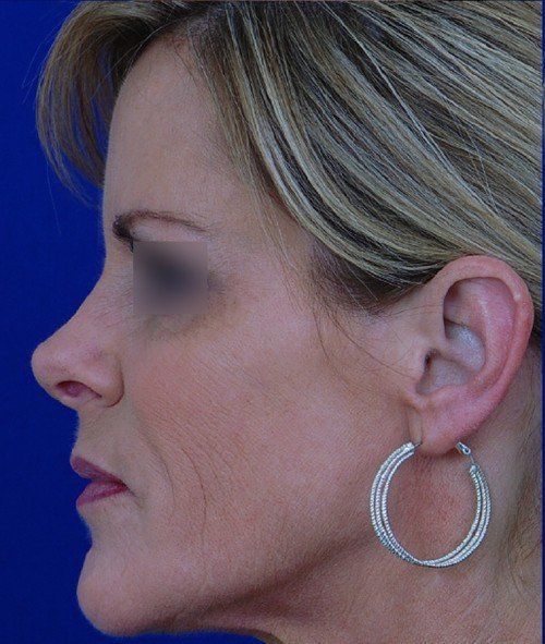 female revision rhinoplasty
