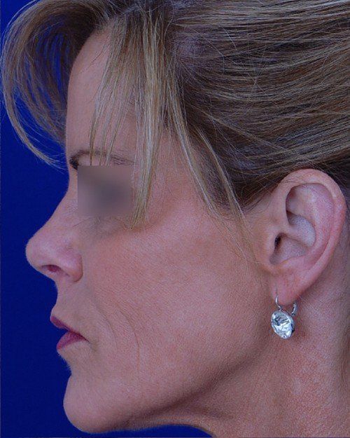 female revision rhinoplasty