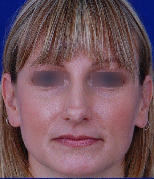 female revision rhinoplasty