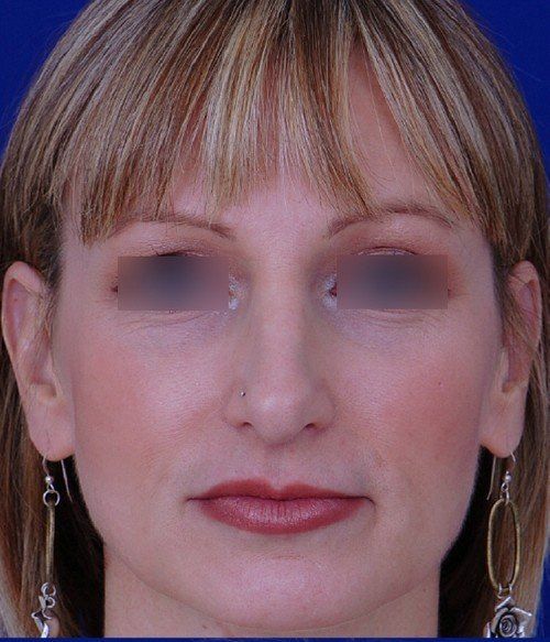 female revision rhinoplasty