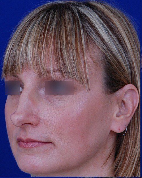 revision rhinoplasty example