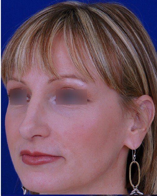 revision rhinoplasty example