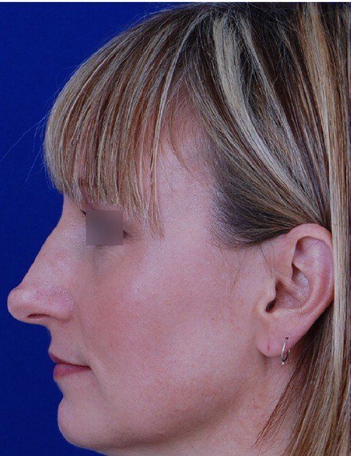 rhinoplasty side profile