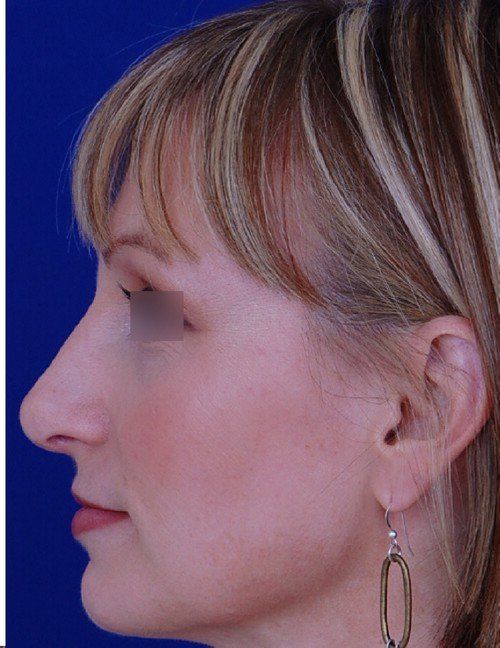 rhinoplasty side profile