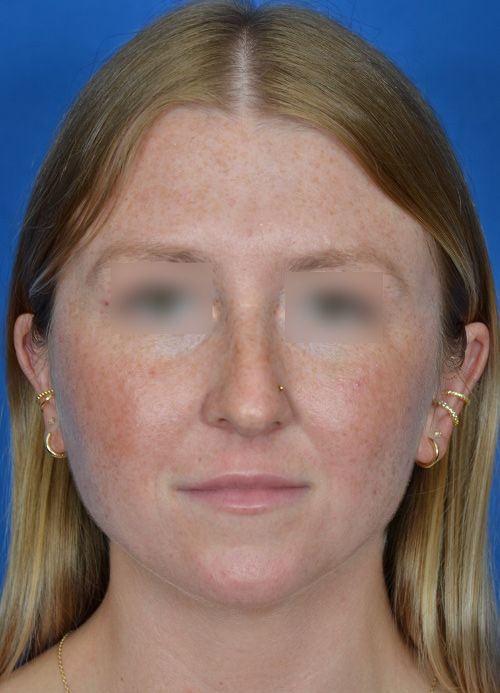 female rhinoplasty