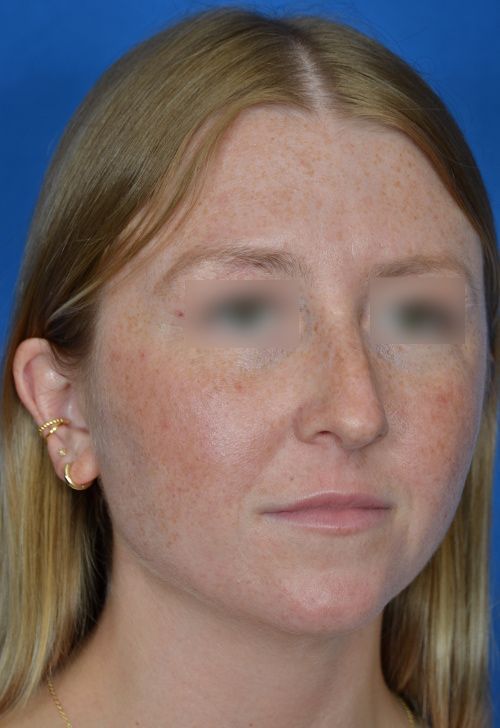 female rhinoplasty