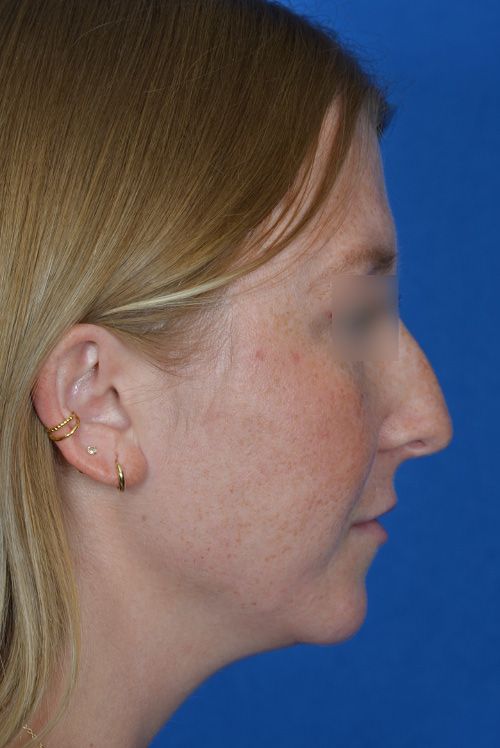male rhinoplasty before