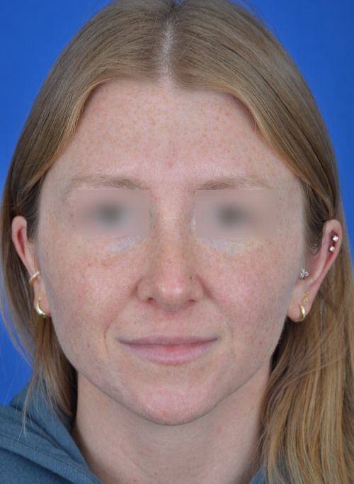 female rhinoplasty