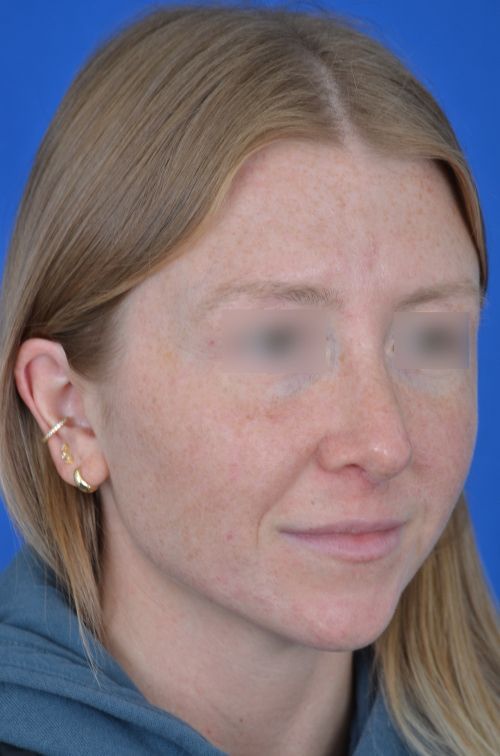 female rhinoplasty