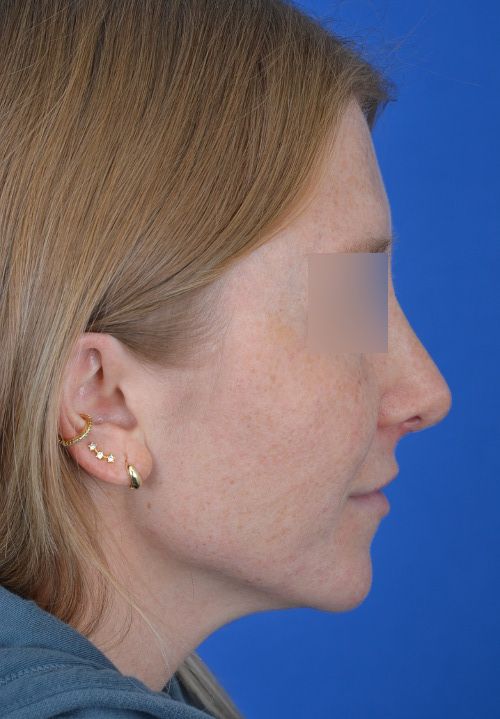 male rhinoplasty after