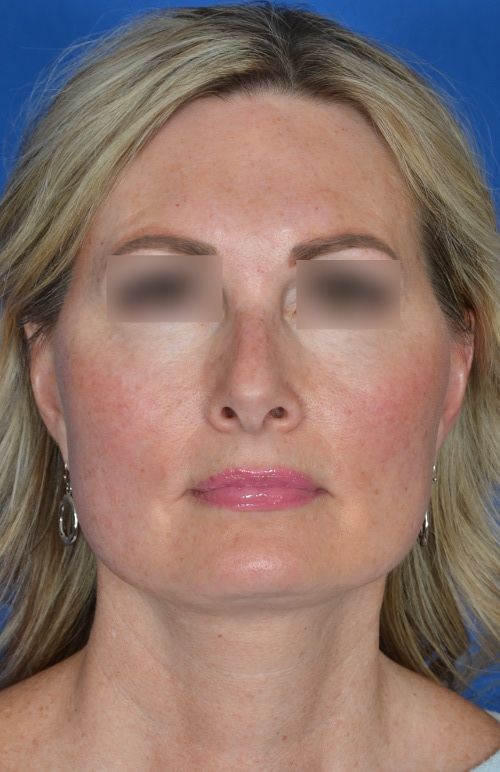 mini facelift before and after
