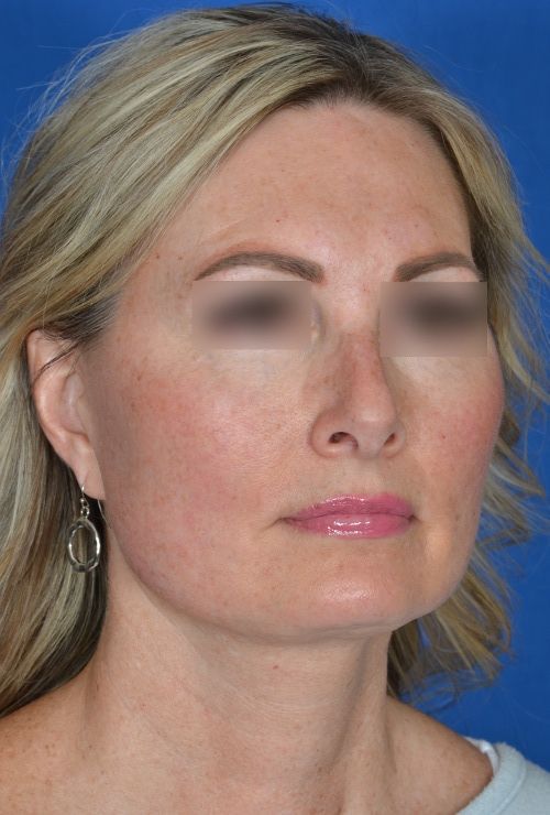 mini facelift before and after