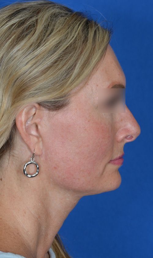 mini facelift before and after