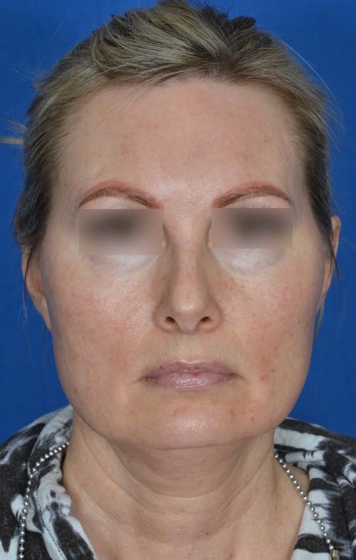 mini facelift before and after