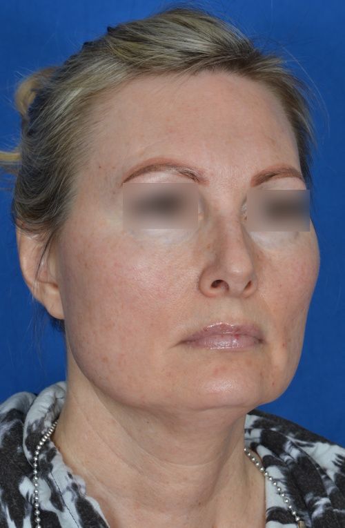 mini facelift before and after